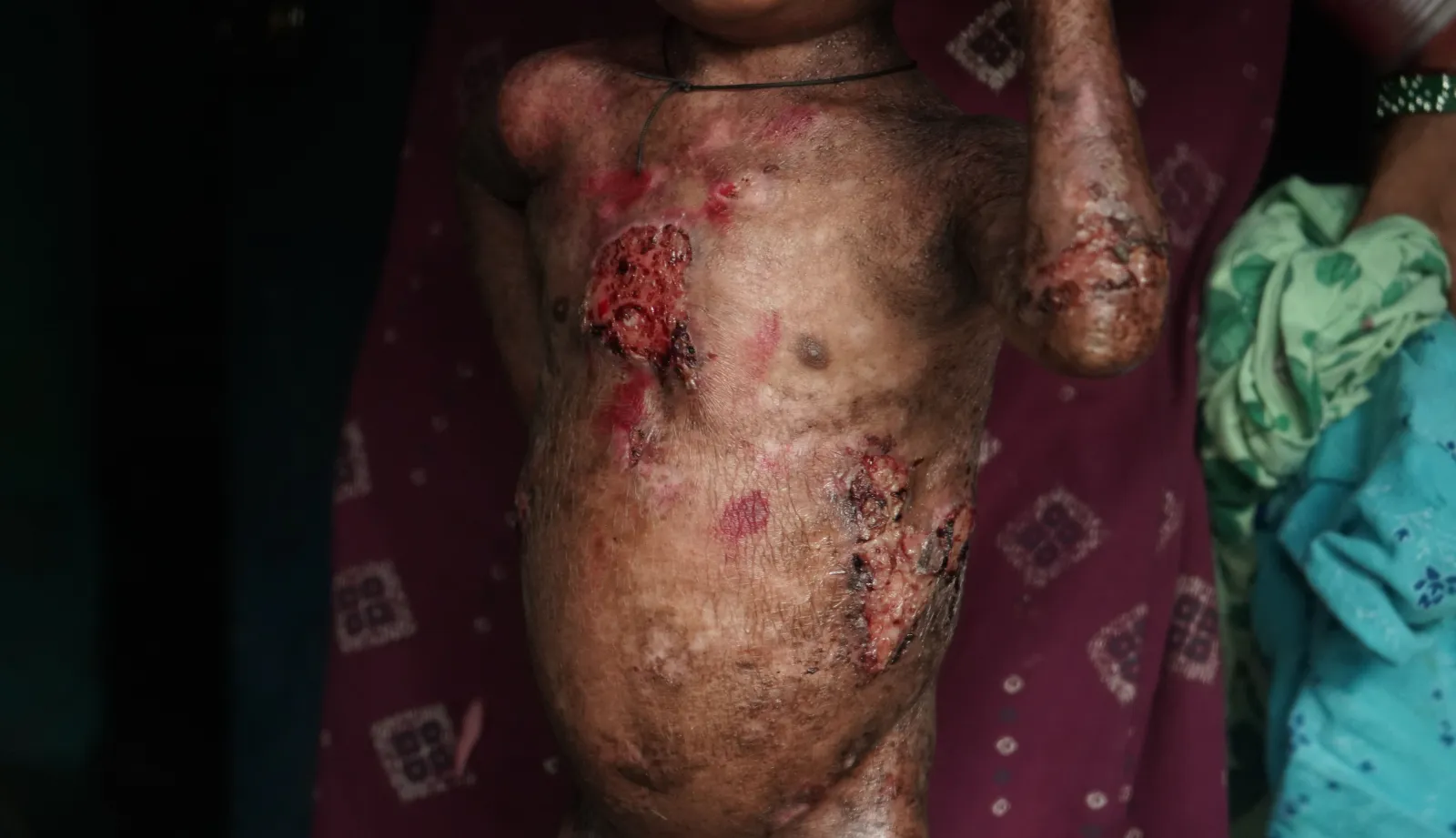 Every Day His Skin Bleeds. Every Day He Still Smiles