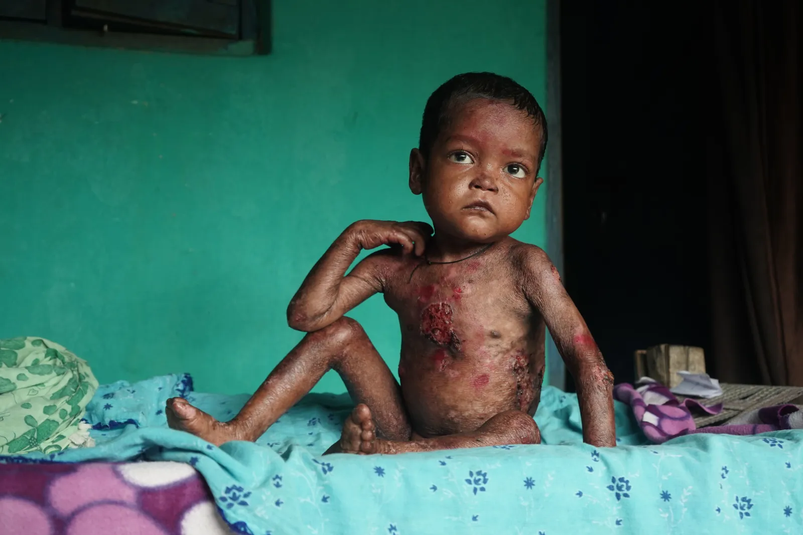 Every Day His Skin Bleeds. Every Day He Still Smiles