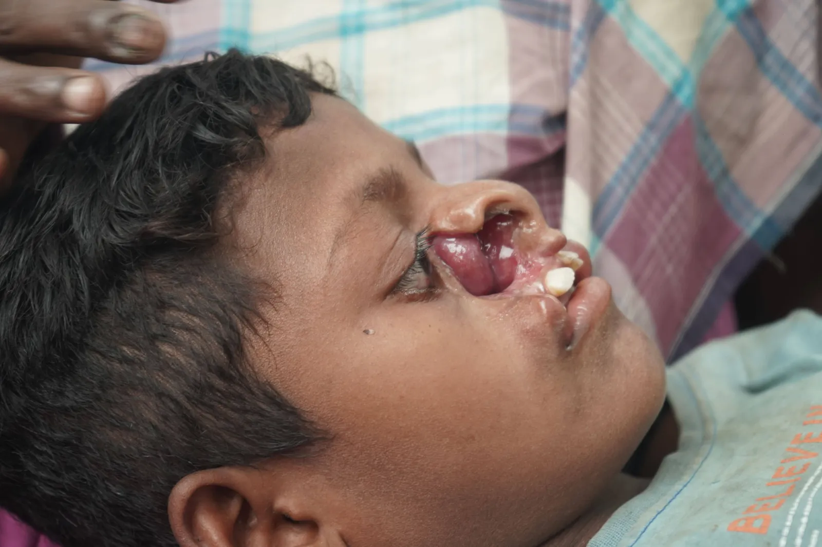 Help a Seven-Year-Old Eat, Smile, and Live Without Pain