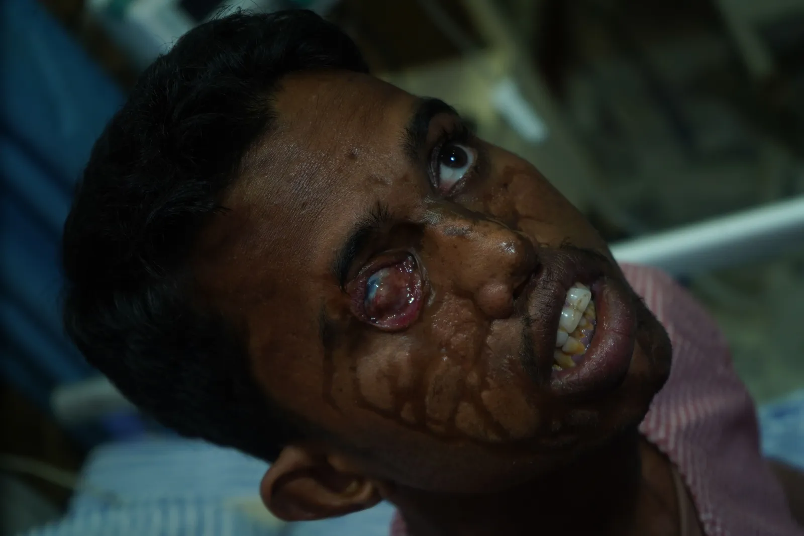 Acid Took His Family. It Should Not Take His Future.