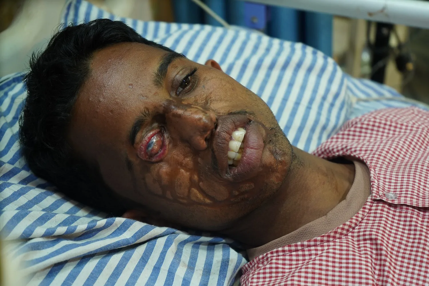 Acid Took His Family. It Should Not Take His Future.