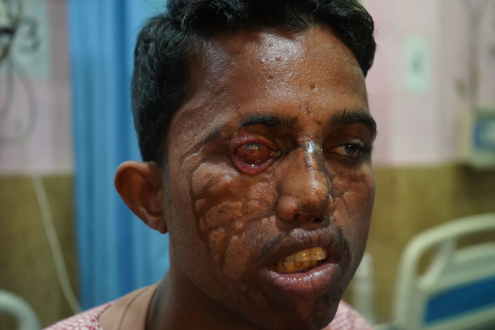 Acid Took His Family. It Should Not Take His Future.