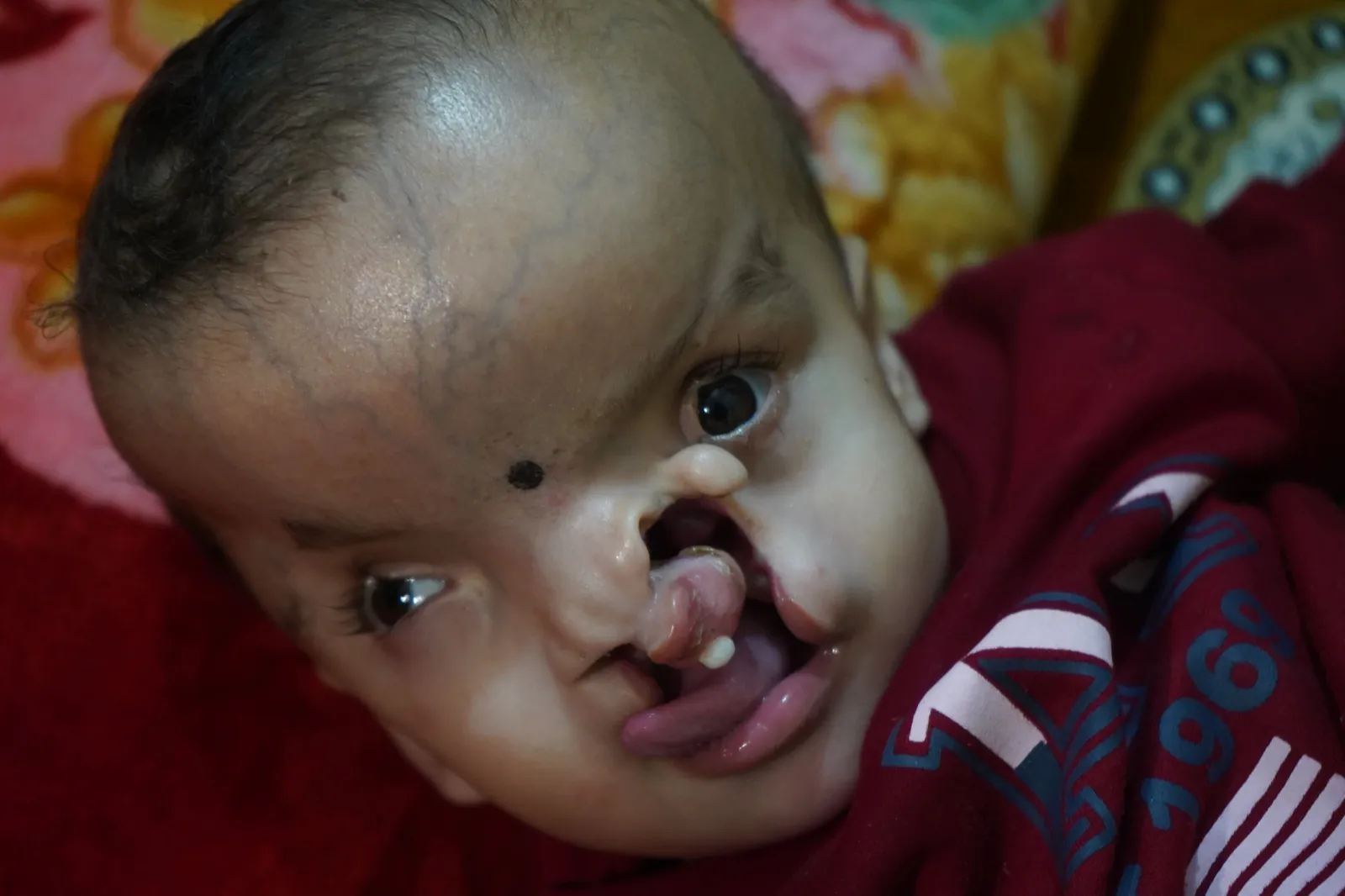 Born Without a Tongue or Teeth. Still Smiling at the World.