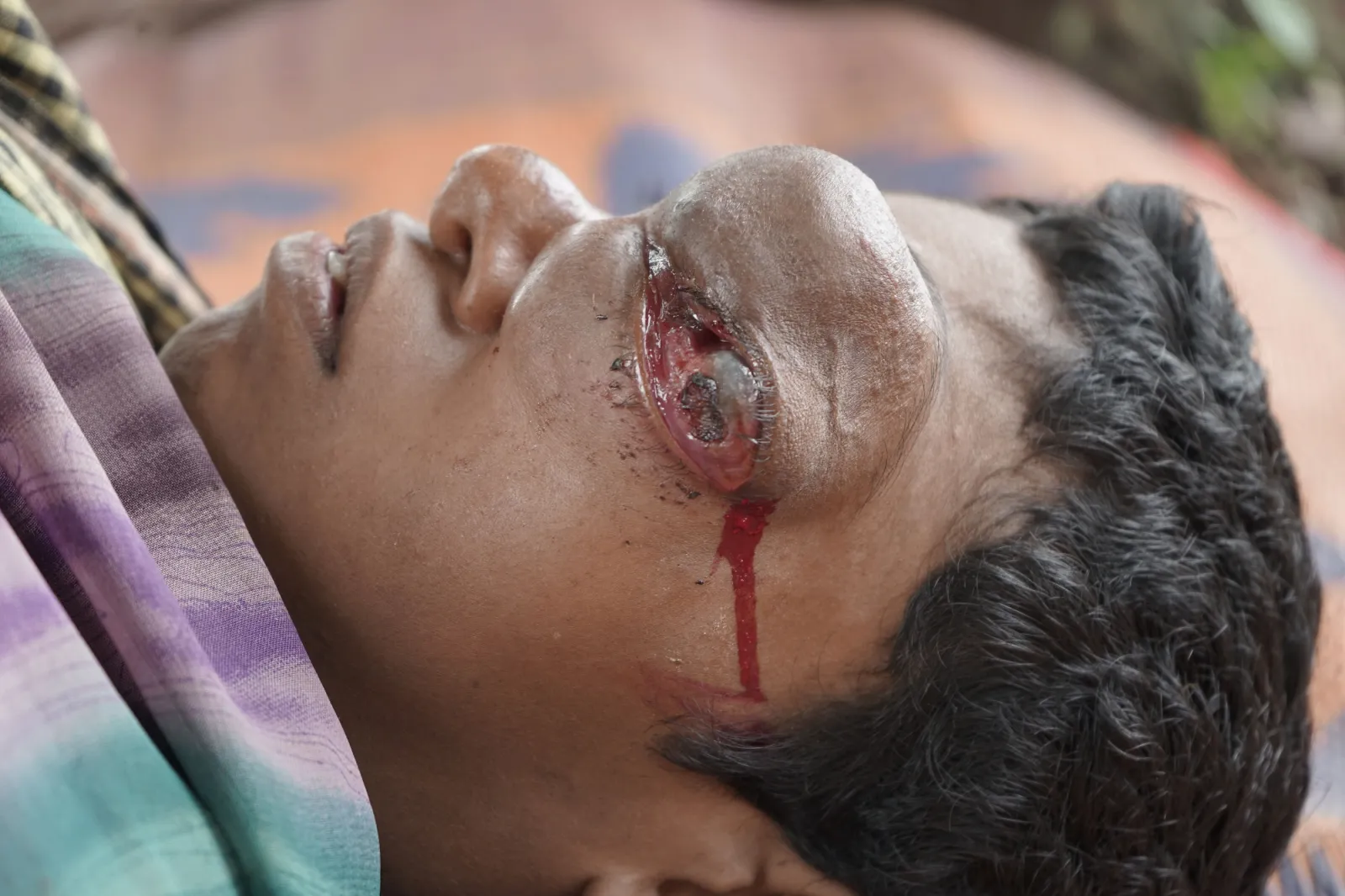Save Malati From Losing Her Eye — And Her Life
