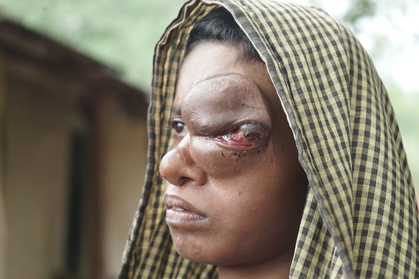 Save Malati From Losing Her Eye — And Her Life