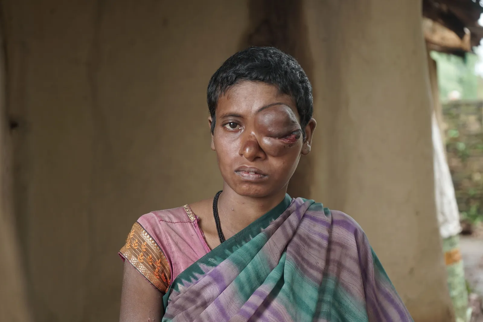 Save Malati From Losing Her Eye — And Her Life