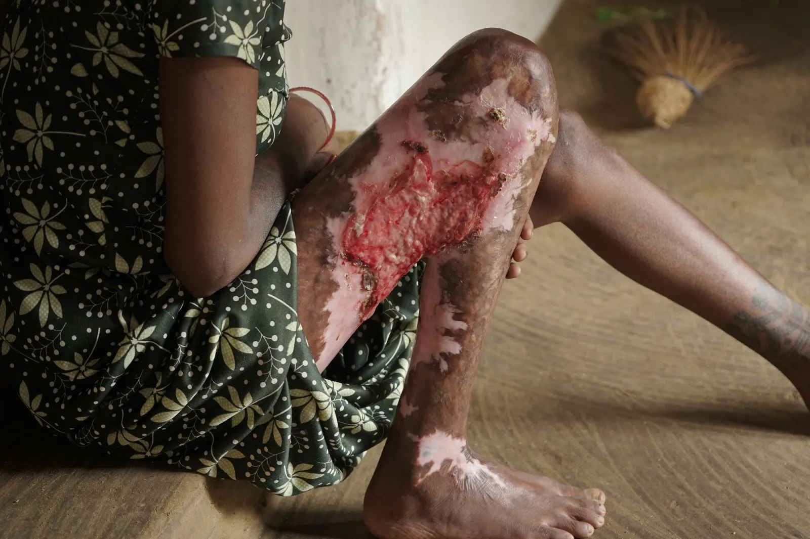 Her Body Burned, Her Spirit Didn’t: Stand With Hirmaniya