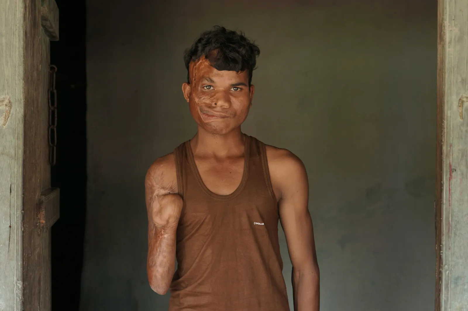 A Fire Took Away His Smile - But Together, We Can Help Chotan Heal