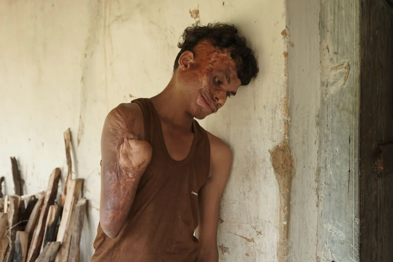 A Fire Took Away His Smile - But Together, We Can Help Chotan Heal