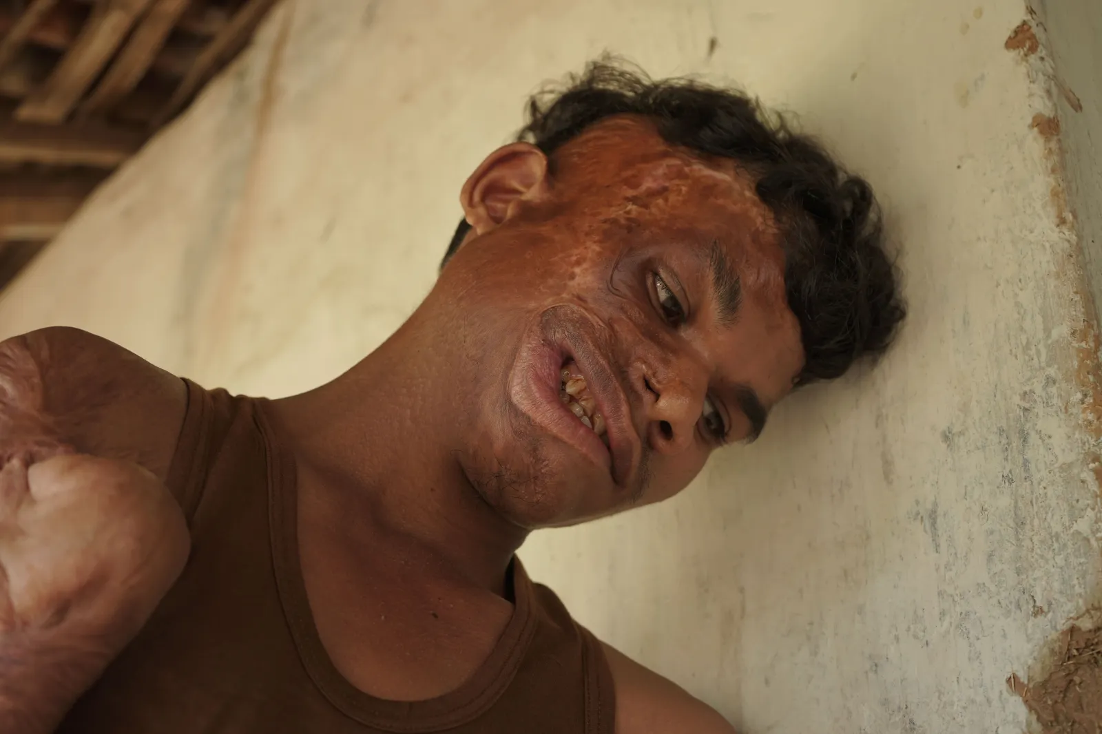 A Fire Took Away His Smile - But Together, We Can Help Chotan Heal