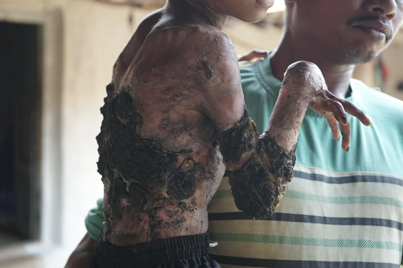 Help Little Kamal Fight the Pain of Fire. He Deserves to Live Without Suffering