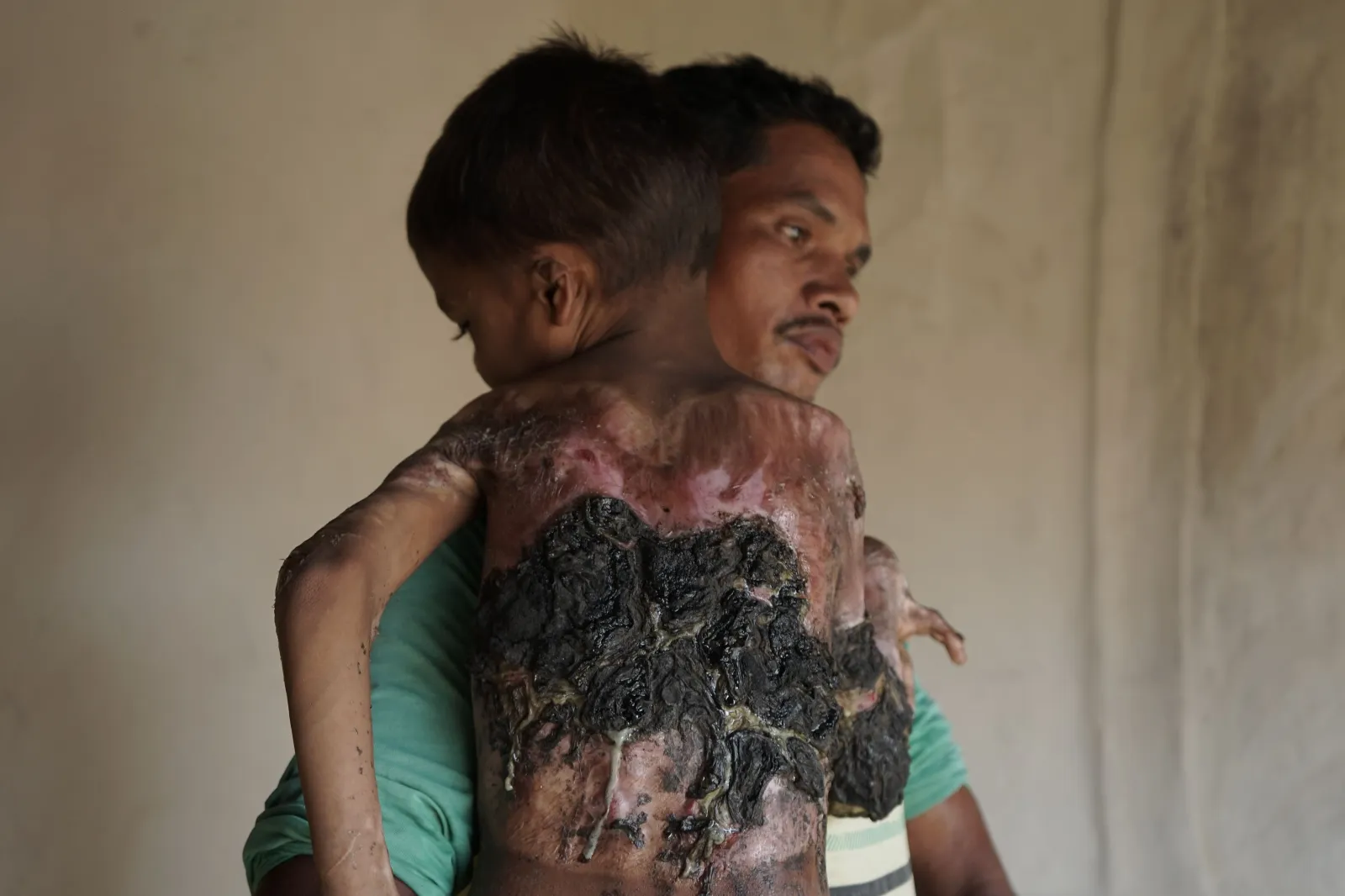 Help Little Kamal Fight the Pain of Fire. He Deserves to Live Without Suffering