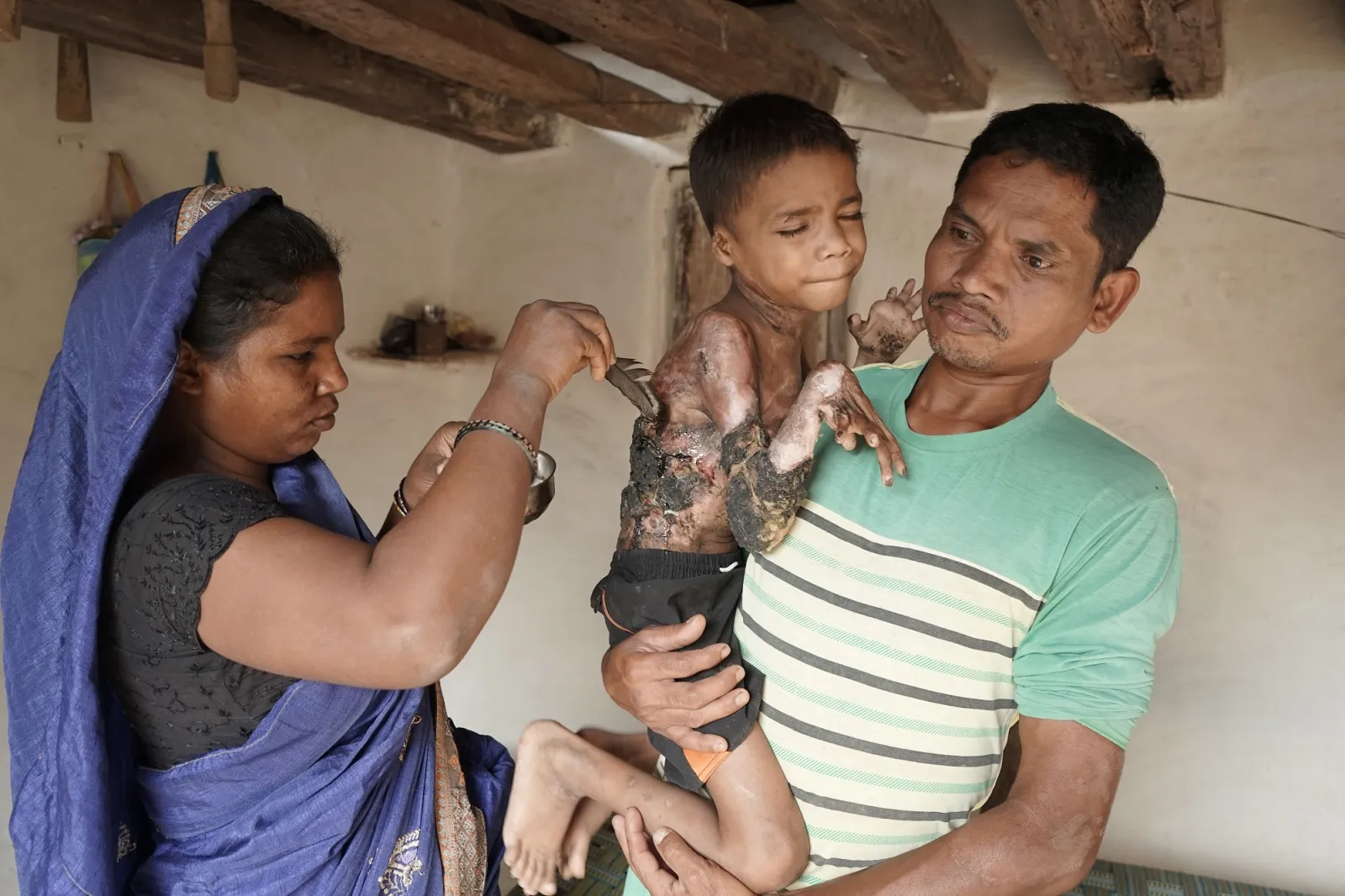 Help Little Kamal Fight the Pain of Fire. He Deserves to Live Without Suffering