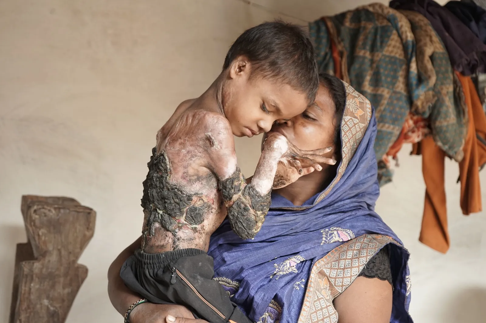 Help Little Kamal Fight the Pain of Fire. He Deserves to Live Without Suffering