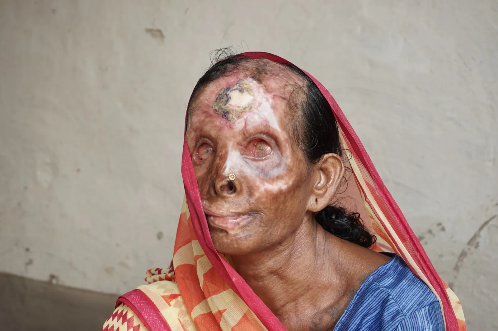 Severe burns. Infections. Pain. And no money for treatment