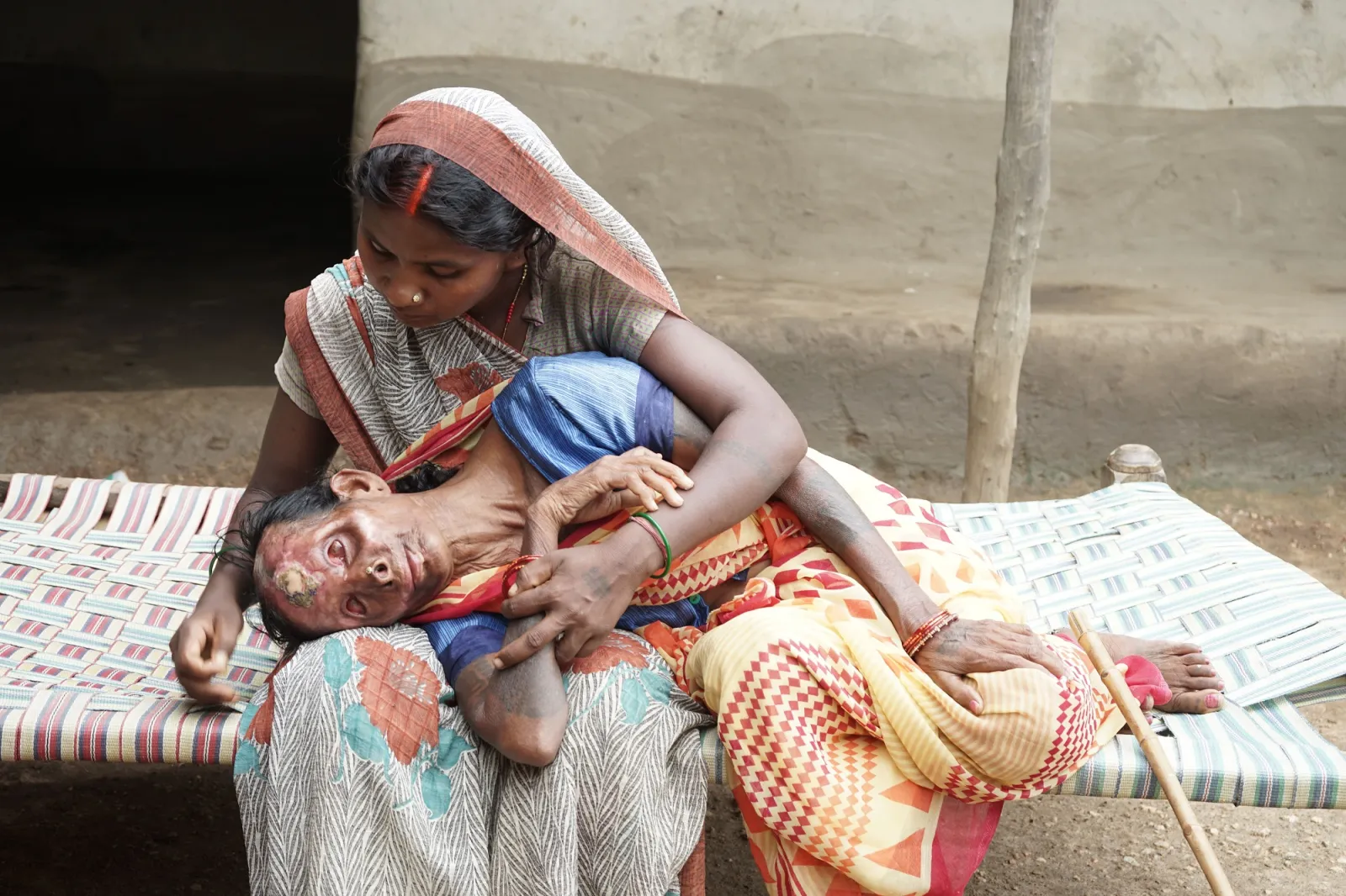 Severe burns. Infections. Pain. And no money for treatment