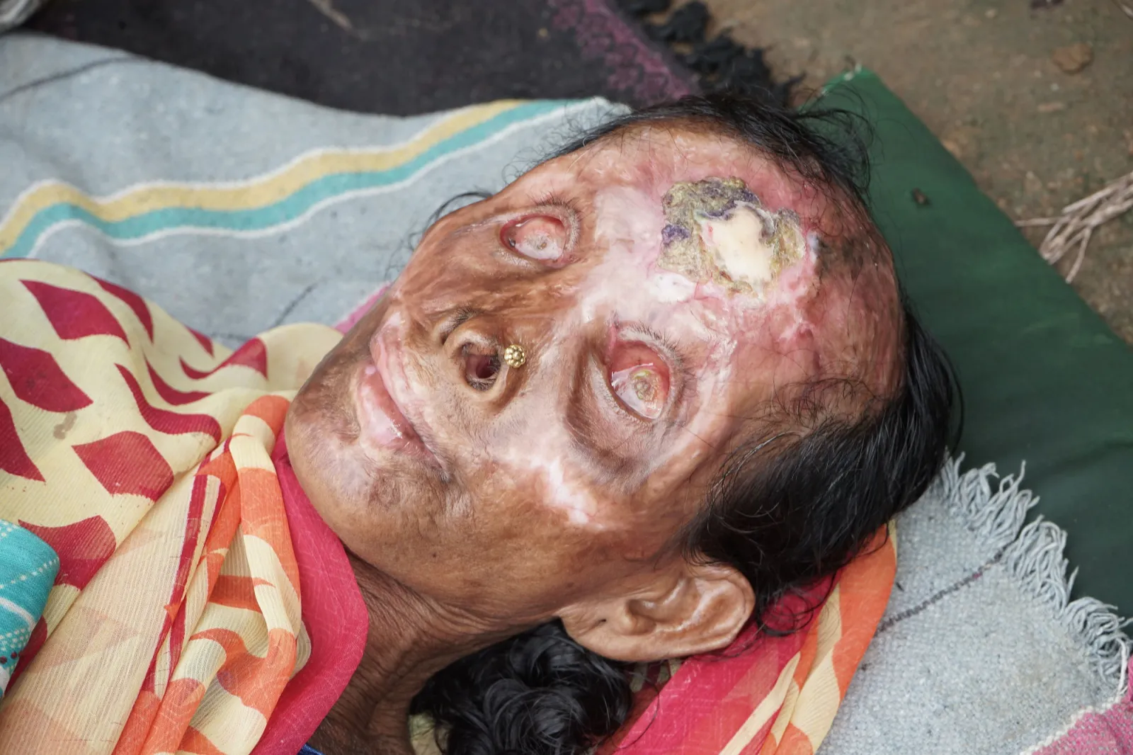 Severe burns. Infections. Pain. And no money for treatment