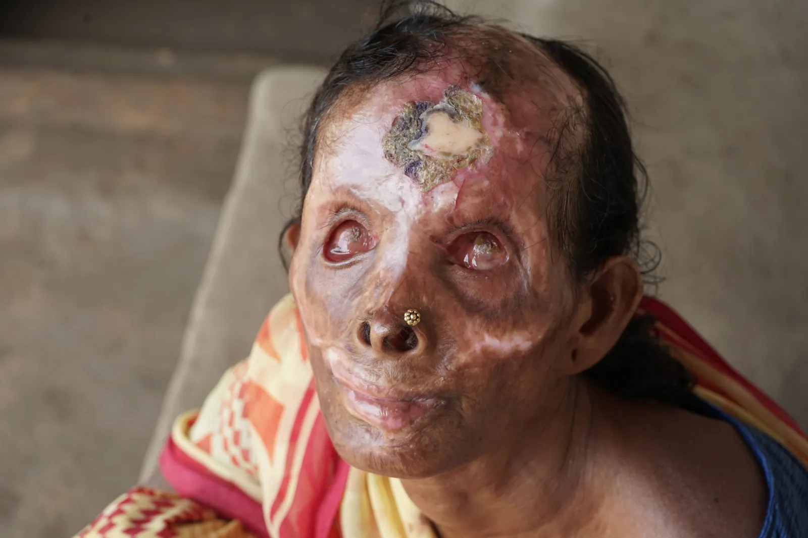 Severe burns. Infections. Pain. And no money for treatment