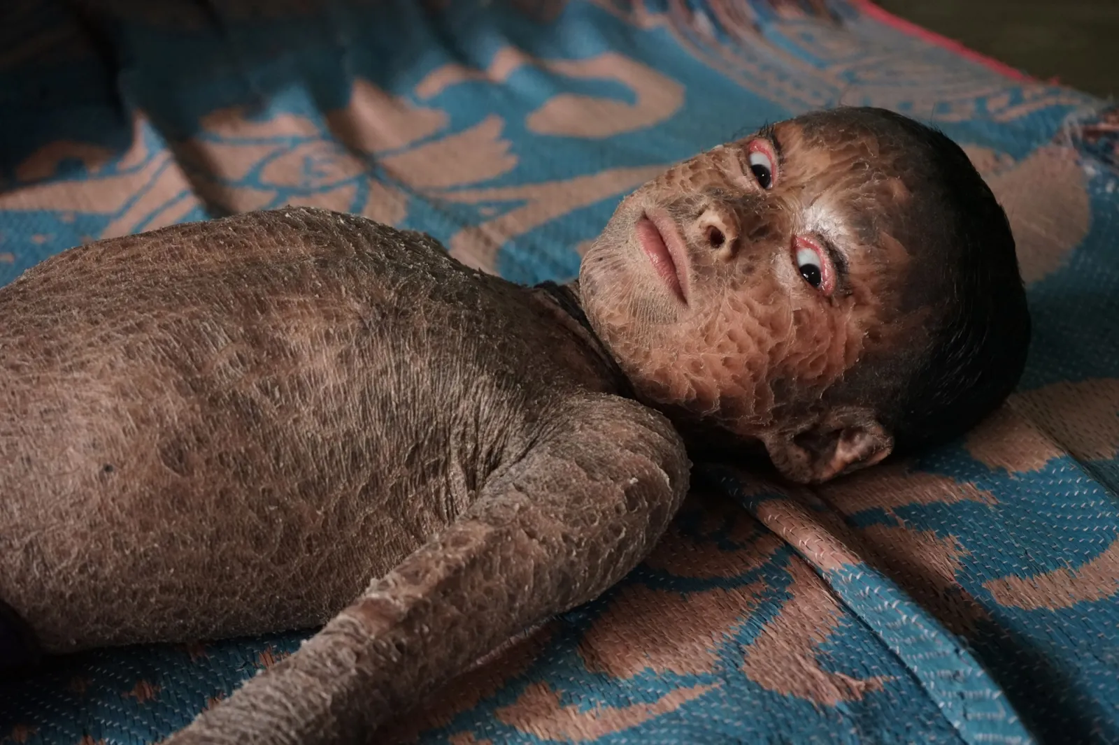 His parents already lost one child to this disease. Please dont let them lose Lukeshwar too.