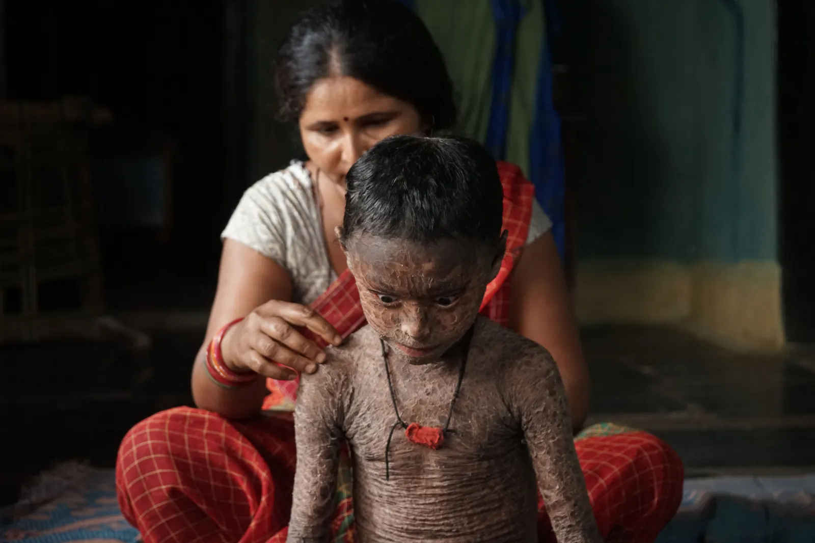 His parents already lost one child to this disease. Please dont let them lose Lukeshwar too.