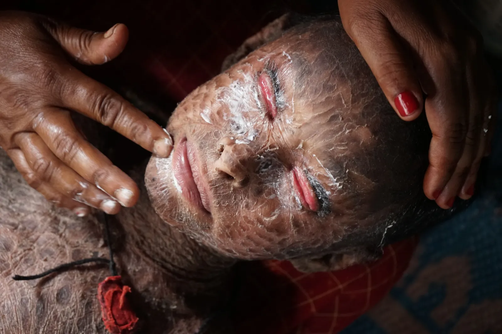 His parents already lost one child to this disease. Please dont let them lose Lukeshwar too.