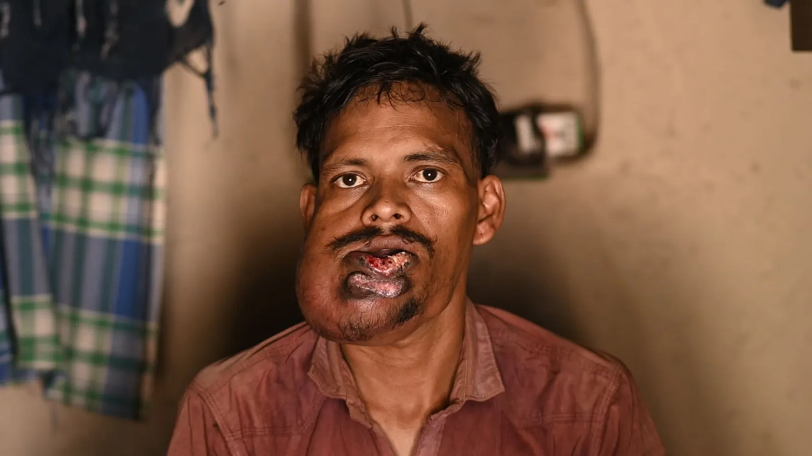 Dukhuram’s Pain Began With a Small Ulcer. Now, It’s growing into a Cancer.