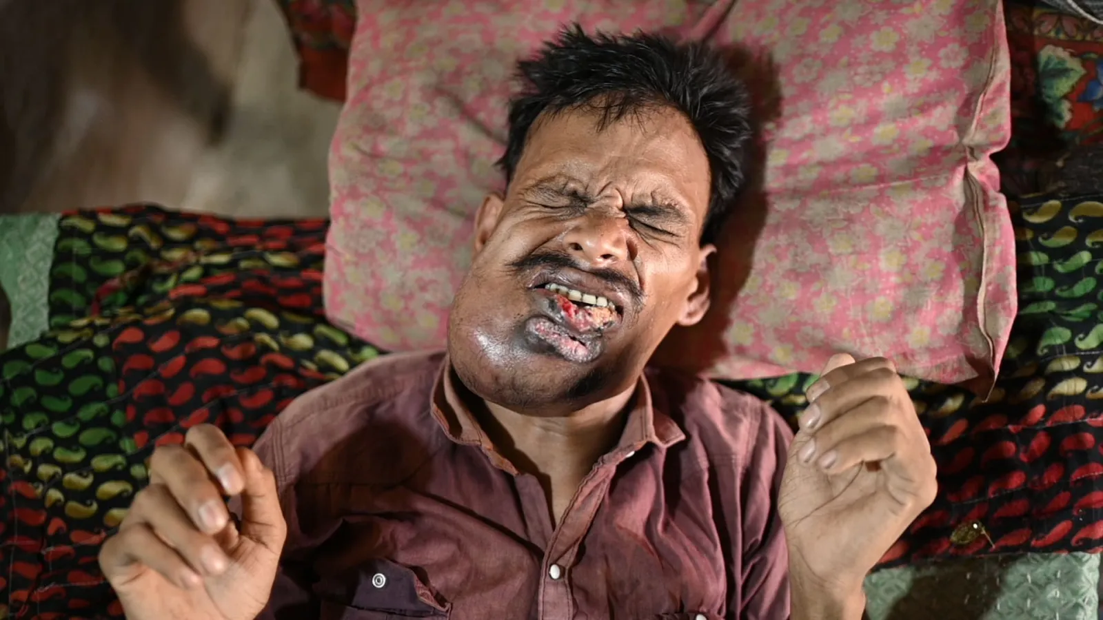 Dukhuram’s Pain Began With a Small Ulcer. Now, It’s growing into a Cancer.