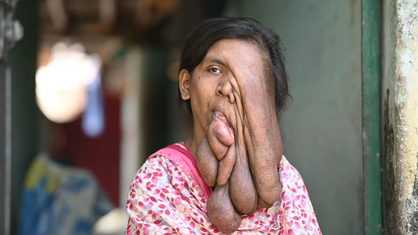 This face scares people. But behind it is just a little girl named Samima.