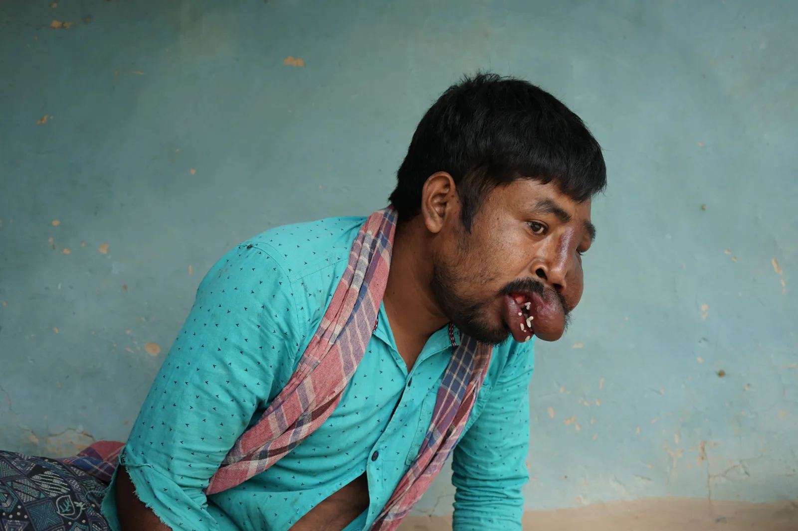 One Surgery. One Chance. One Life Changed – Support Nipen Today