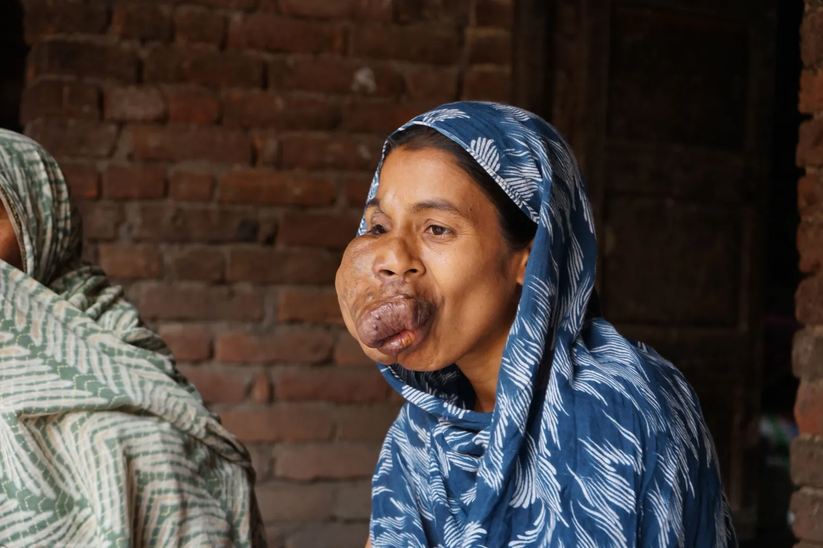 Trapped by Pain, Silenced by Stares — Mosima Needs Us to Help Her Heal