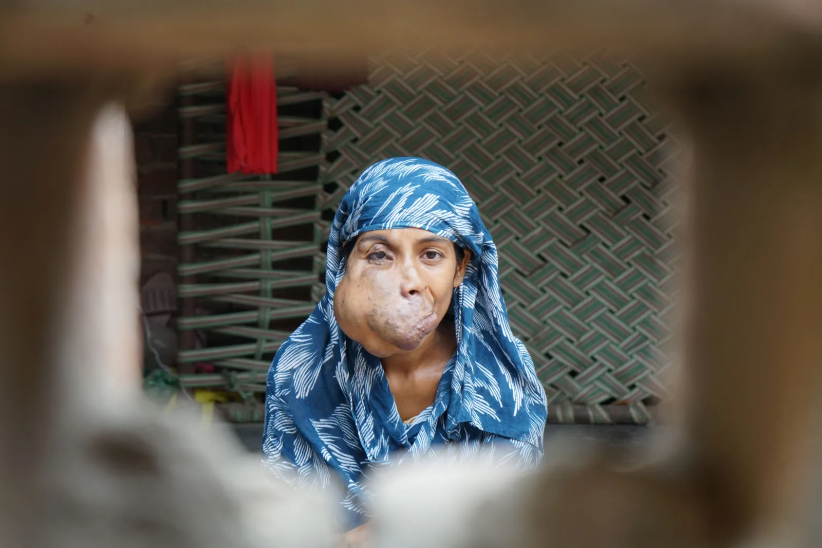 Trapped by Pain, Silenced by Stares — Mosima Needs Us to Help Her Heal
