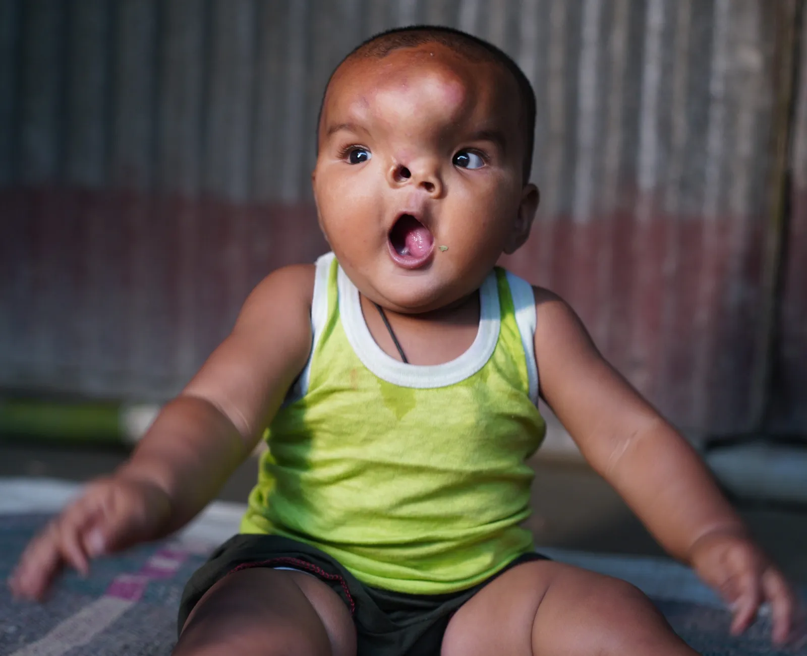 Help Baby Arphina Khatun Win Against Two Tumors