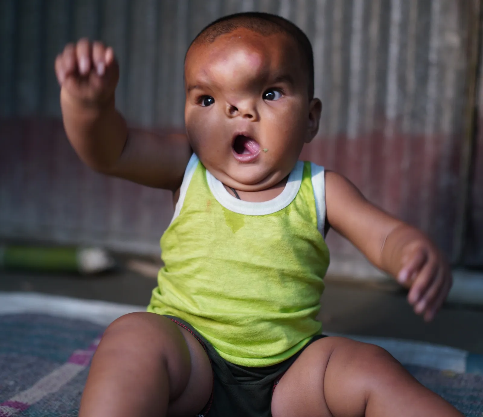 Help Baby Arphina Khatun Win Against Two Tumors