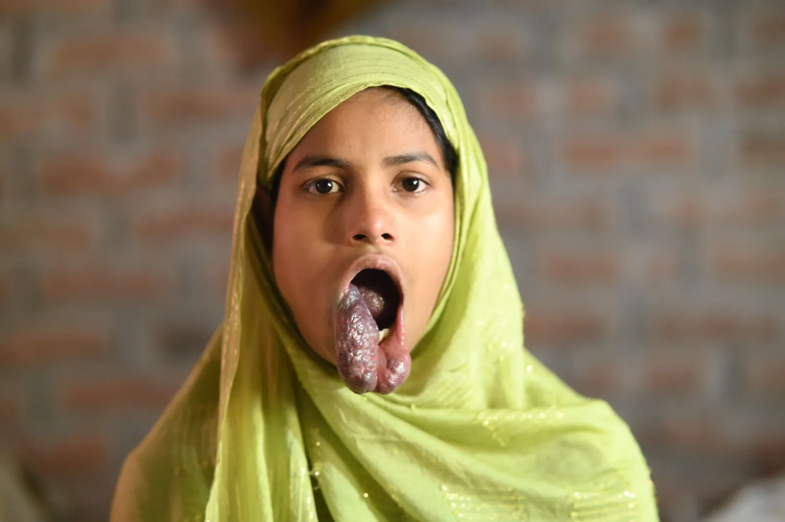 Help Asha See a Brighter Tomorrow – She Needs Urgent Surgery!