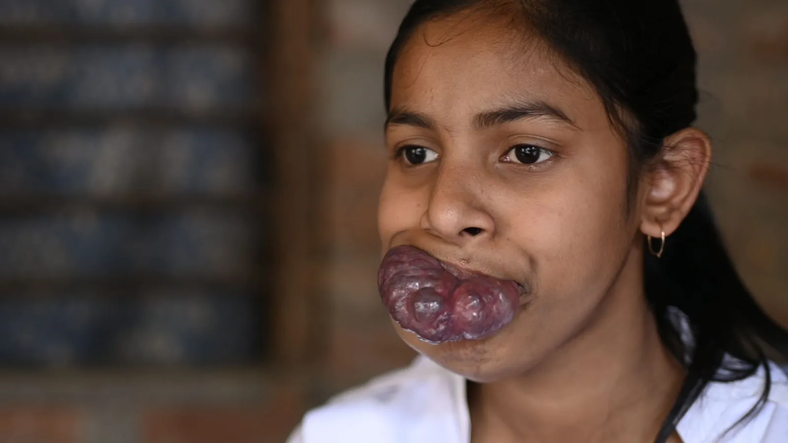 Help Asha See a Brighter Tomorrow – She Needs Urgent Surgery!