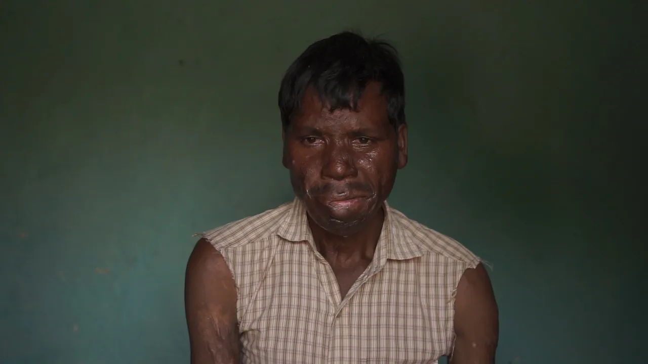 Help Kuldeep Hold His Children Again – Restore His Hands, Restore His Hope