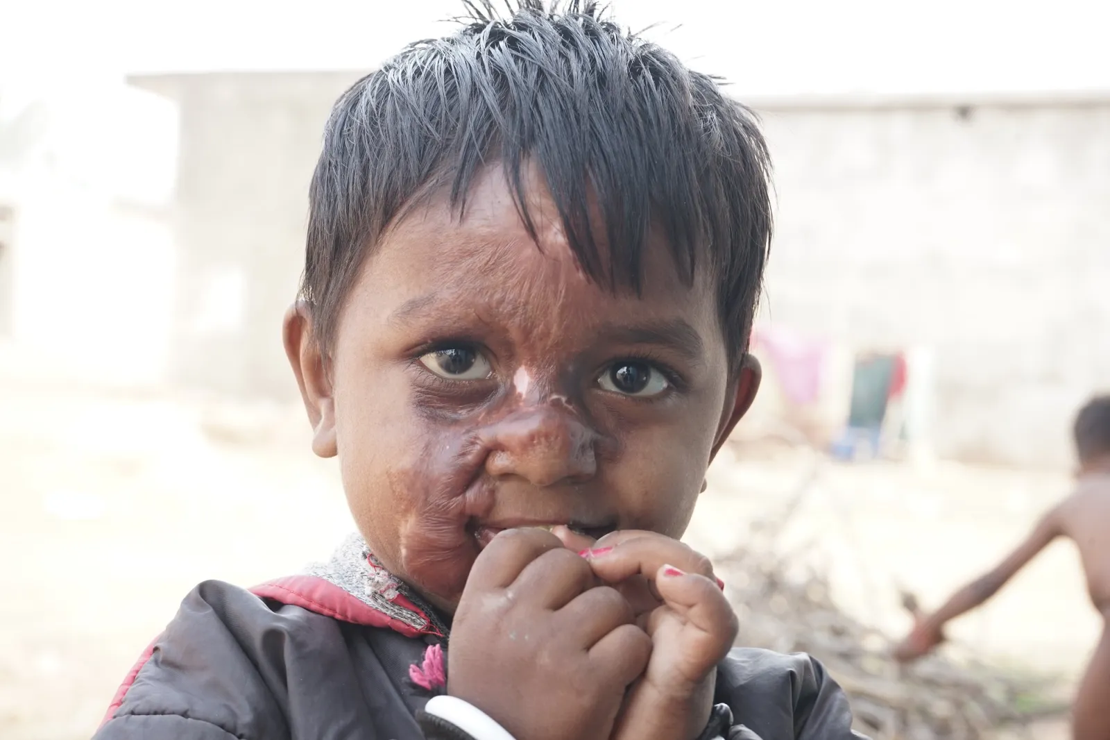 Sachin's Scarred Smile: A Plea for Help