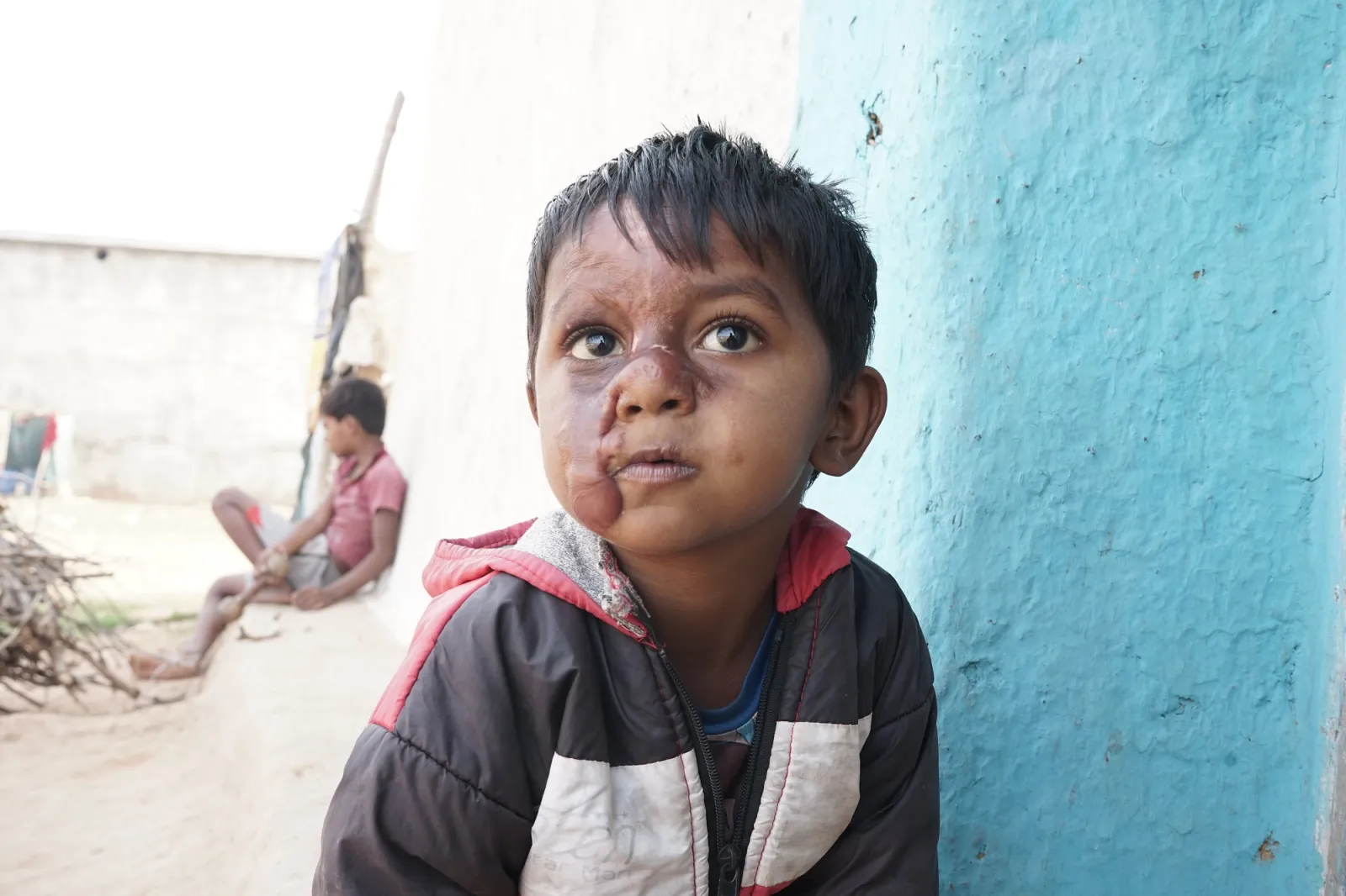 Sachin's Scarred Smile: A Plea for Help