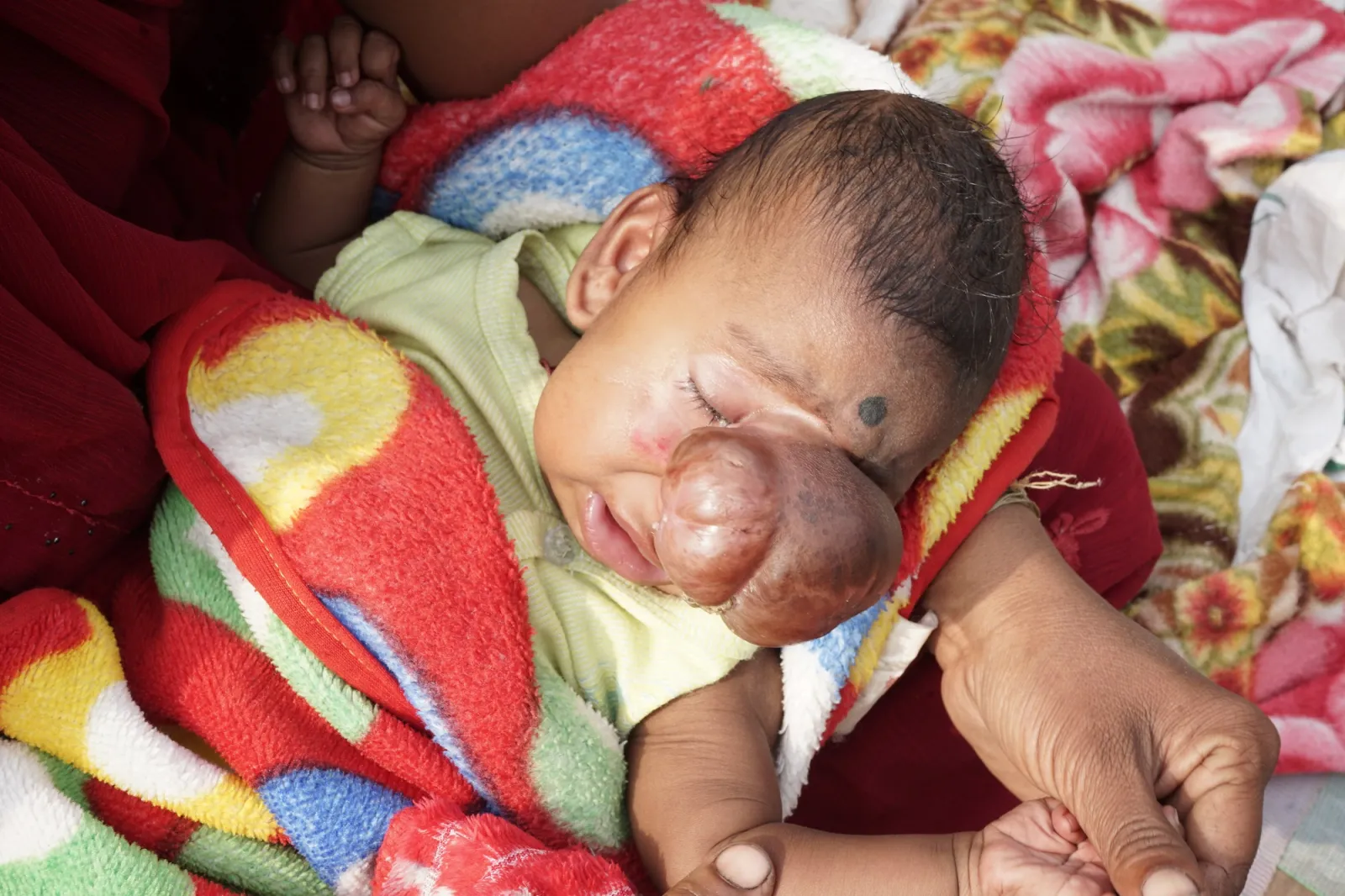 A Tiny Heart, a Mighty Fight: Sarthi's Battle for Life