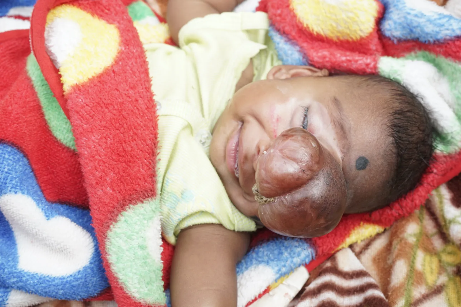 A Tiny Heart, a Mighty Fight: Sarthi's Battle for Life