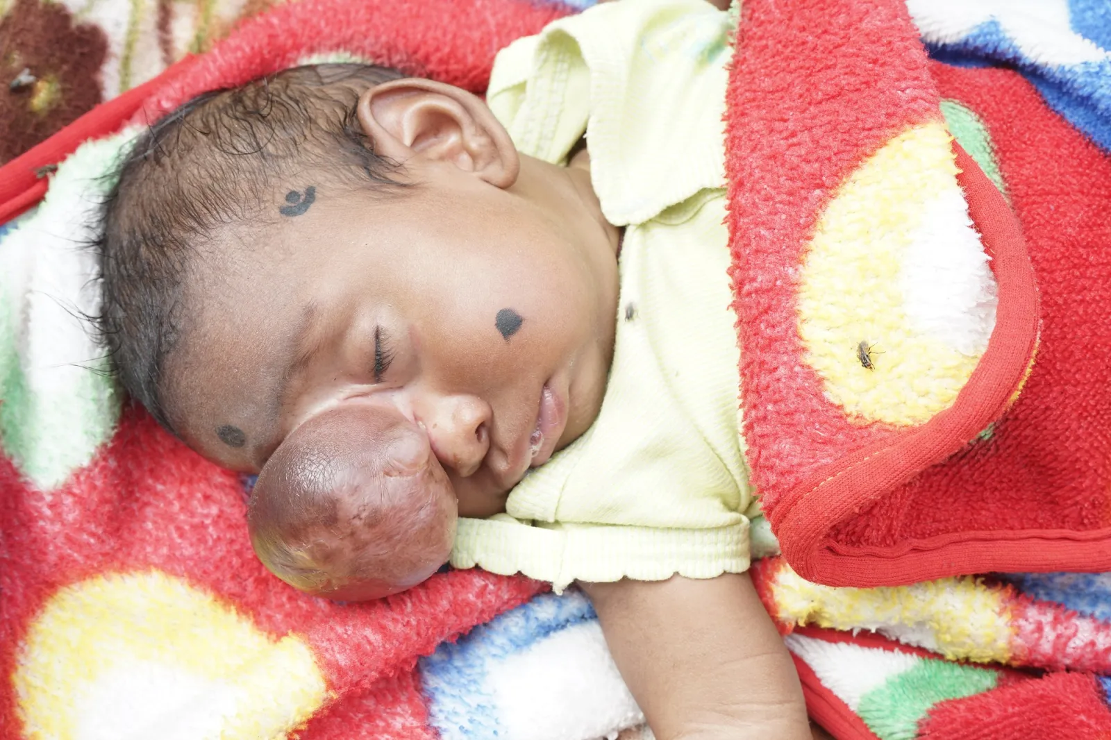 A Tiny Heart, a Mighty Fight: Sarthi's Battle for Life