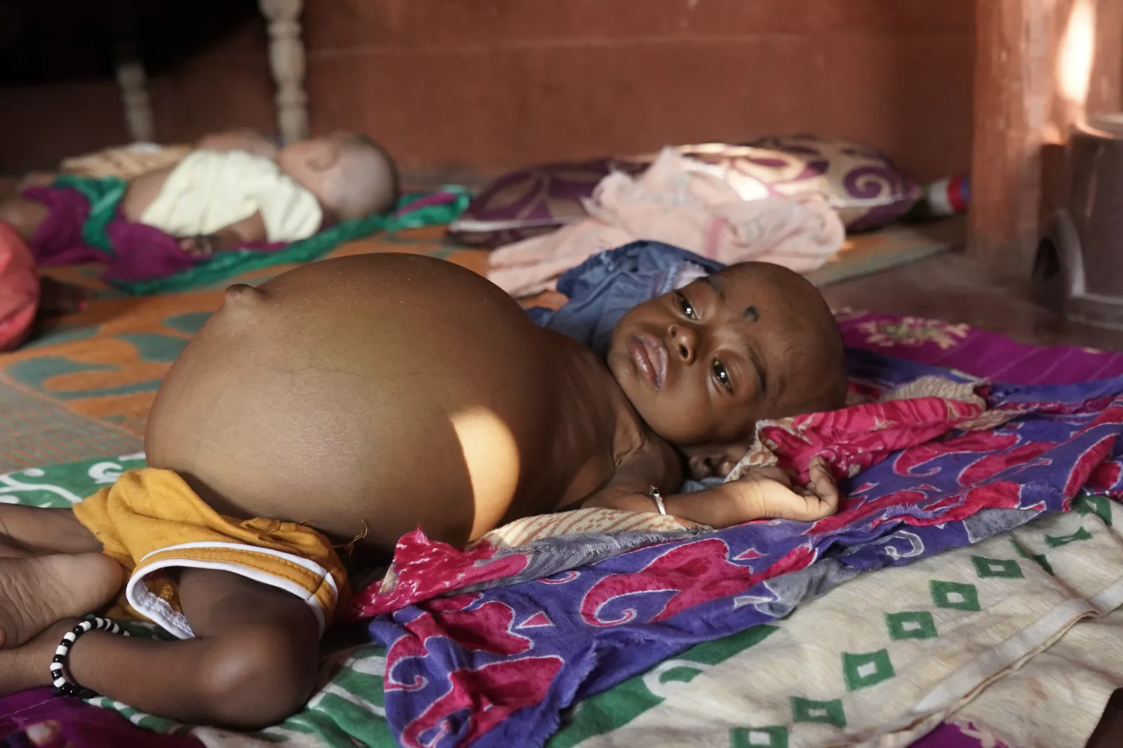 She Is 10 Months Old. Her Father Sweeps Homes to Feed Five People. Now One of Them Is Dying.
