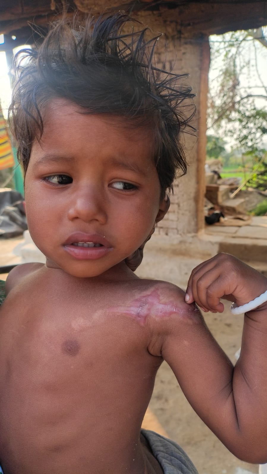 Sanjana Barles Journey to Recovery